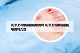乳暈上有銀屑病能喂奶嗎 乳暈上有銀屑病能喂奶嗎女性