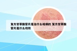 復(fù)方甘草酸苷片是治什么啥病的 復(fù)方甘草酸苷片是什么功效