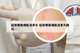 后背銀屑病能活多久 后背銀屑病能活多久圖片