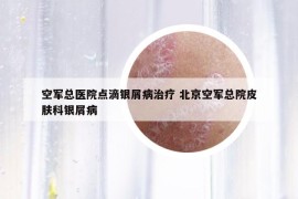 空軍總醫(yī)院點(diǎn)滴銀屑病治療 北京空軍總院皮膚科銀屑病