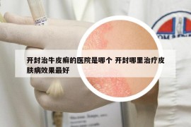 開封治牛皮癬的醫(yī)院是哪個 開封哪里治療皮膚病效果最好