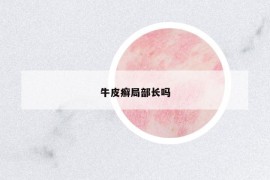 牛皮癬局部長嗎