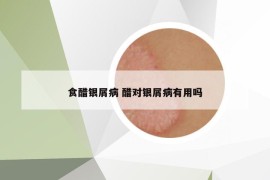 食醋銀屑病 醋對銀屑病有用嗎