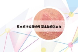 草本癬凈效果好嗎 草本祛癬怎么樣
