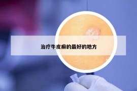 治療牛皮癬的最好的地方