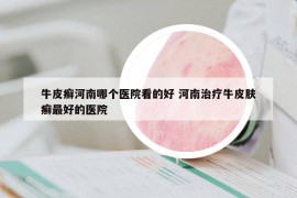 牛皮癬河南哪個醫(yī)院看的好 河南治療牛皮膚癬最好的醫(yī)院