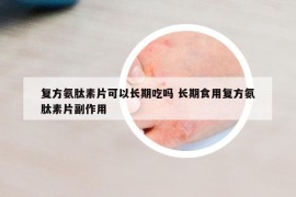 復(fù)方氨肽素片可以長期吃嗎 長期食用復(fù)方氨肽素片副作用