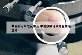 牛皮癬可以吃花生么 牛皮膚癬可以吃花生毛豆嗎