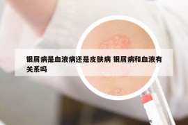 銀屑病是血液病還是皮膚病 銀屑病和血液有關系嗎