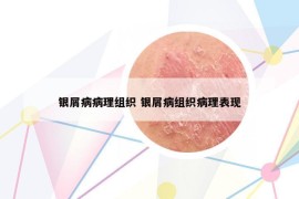 銀屑病病理組織 銀屑病組織病理表現(xiàn)