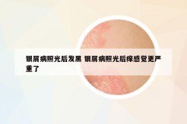 銀屑病照光后發(fā)黑 銀屑病照光后癢感覺(jué)更嚴(yán)重了