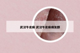 武漢牛皮癬 武漢牛皮癬病友群