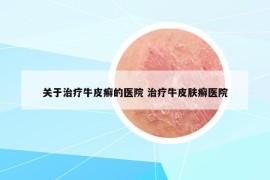 關(guān)于治療牛皮癬的醫(yī)院 治療牛皮膚癬醫(yī)院