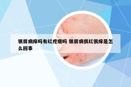 銀屑病癢嗎有紅疙瘩嗎 銀屑病很紅很癢是怎么回事