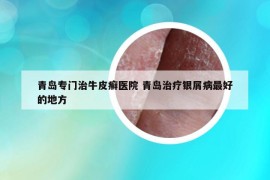 青島專門治牛皮癬醫(yī)院 青島治療銀屑病最好的地方
