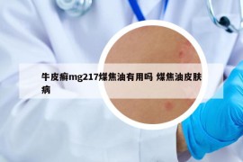 牛皮癬mg217煤焦油有用嗎 煤焦油皮膚病