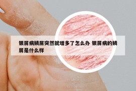 銀屑病鱗屑突然就增多了怎么辦 銀屑病的鱗屑是什么樣