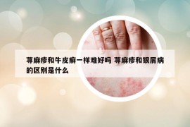蕁麻疹和牛皮癬一樣難好嗎 蕁麻疹和銀屑病的區(qū)別是什么