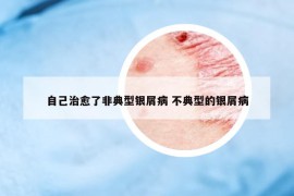 自己治愈了非典型銀屑病 不典型的銀屑病