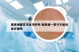 銀屑病要忌河魚河蝦嗎 銀屑病一輩子不能吃魚蝦蟹嗎