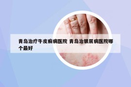 青島治療牛皮癬病醫(yī)院 青島治銀屑病醫(yī)院哪個(gè)最好