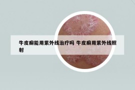 牛皮癬能用紫外線治療嗎 牛皮癬用紫外線照射