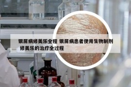 銀屑病修美樂全程 銀屑病患者使用生物制劑 修美樂的治療全過程