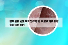 銀屑病用的紫草膏怎樣炮制 銀屑病用的紫草膏怎樣炮制的