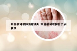 銀屑病可以抹清涼油嗎 銀屑病可以抹什么潤(rùn)膚劑
