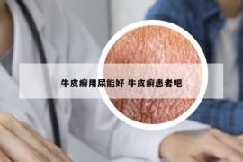 牛皮癬用尿能好 牛皮癬患者吧