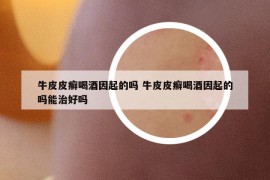 牛皮皮癬喝酒因起的嗎 牛皮皮癬喝酒因起的嗎能治好嗎