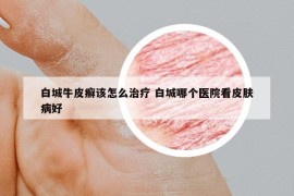 白城牛皮癬該怎么治療 白城哪個醫(yī)院看皮膚病好