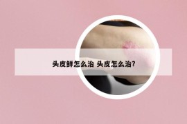 頭皮鮮怎么治 頭皮怎么治?