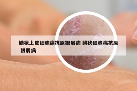 鱗狀上皮細胞癌抗原銀屑病 鱗狀細胞癌抗原 銀屑病
