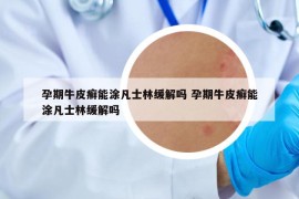 孕期牛皮癬能涂凡士林緩解嗎 孕期牛皮癬能涂凡士林緩解嗎