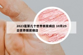 2023是第幾個世界銀屑病日 10月29日世界銀屑病日