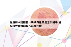 屁股和大腿根有一塊塊白色的是怎么回事 屁股和大腿根部長凸起紅疙瘩