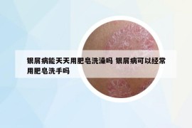 銀屑病能天天用肥皂洗澡嗎 銀屑病可以經(jīng)常用肥皂洗手嗎