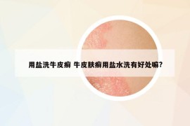 用鹽洗牛皮癬 牛皮膚癬用鹽水洗有好處嘛?