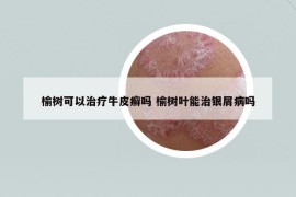 榆樹可以治療牛皮癬嗎 榆樹葉能治銀屑病嗎