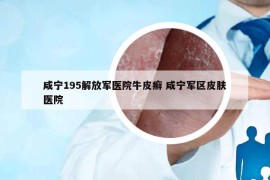 咸寧195解放軍醫(yī)院牛皮癬 咸寧軍區(qū)皮膚醫(yī)院
