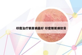 印度治療銀屑病最好 印度銀屑病軟膏