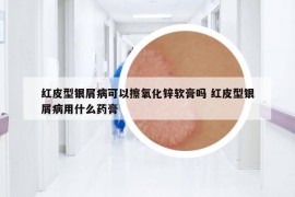 紅皮型銀屑病可以擦氧化鋅軟膏嗎 紅皮型銀屑病用什么藥膏