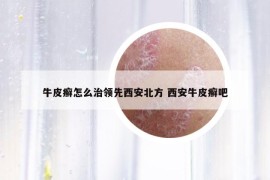 牛皮癬怎么治領(lǐng)先西安北方 西安牛皮癬吧