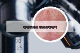 嗜睡銀屑病 銀屑病嗜睡嗎