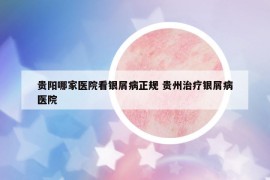 貴陽哪家醫(yī)院看銀屑病正規(guī) 貴州治療銀屑病醫(yī)院