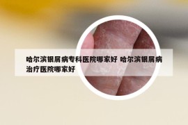 哈爾濱銀屑病?？漆t(yī)院哪家好 哈爾濱銀屑病治療醫(yī)院哪家好