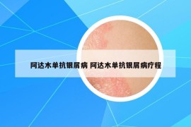 阿達(dá)木單抗銀屑病 阿達(dá)木單抗銀屑病療程