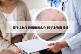 脖子上長了蘚很癢怎么辦 脖子上張?zhí)\很癢