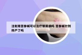 注射用苦參堿可以治療銀屑病嗎 苦參堿針劑停產(chǎn)了嗎